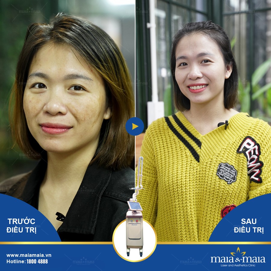 Mẫu content trị nám - Da liễu Maia